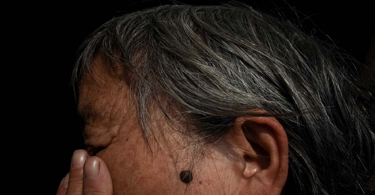66歲的吳瓊瑤臉上的砷斑日益加重。