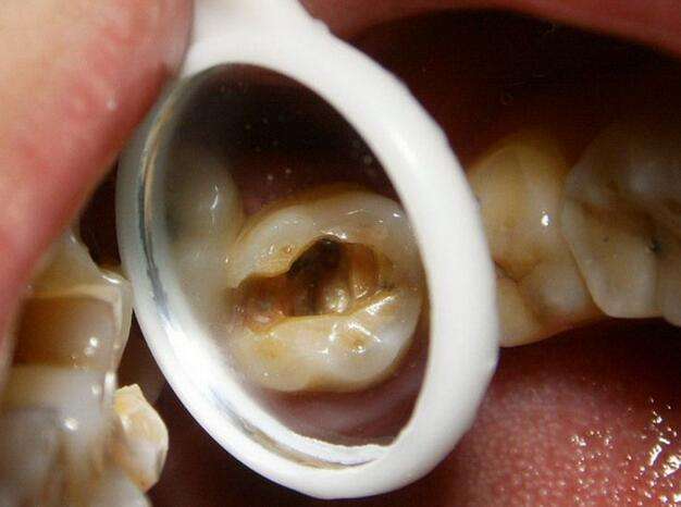 門牙齲齒
