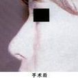 口角成型術 口角成型術