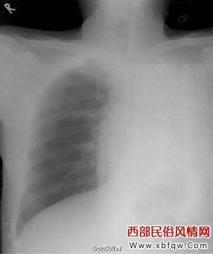 肺萎 肺萎