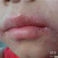光線性唇炎 光線性唇炎