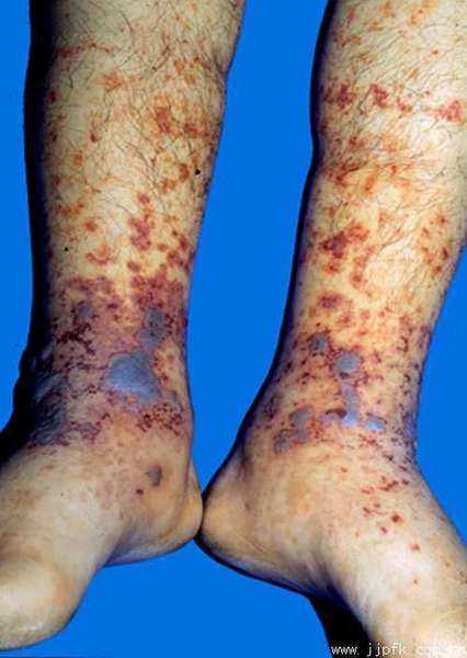 皮疹是紫癜最常見的臨床表現.