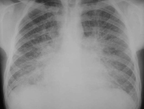 間質性肺水腫