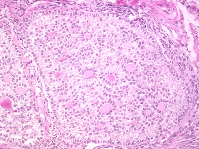 卵巢性索間質腫瘤