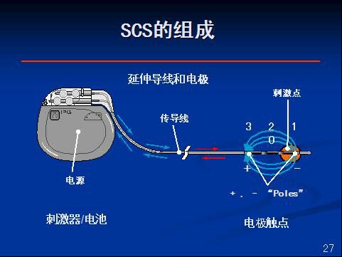 脊髓刺激器 脊髓刺激器