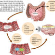 IBS(腸易激綜合徵)