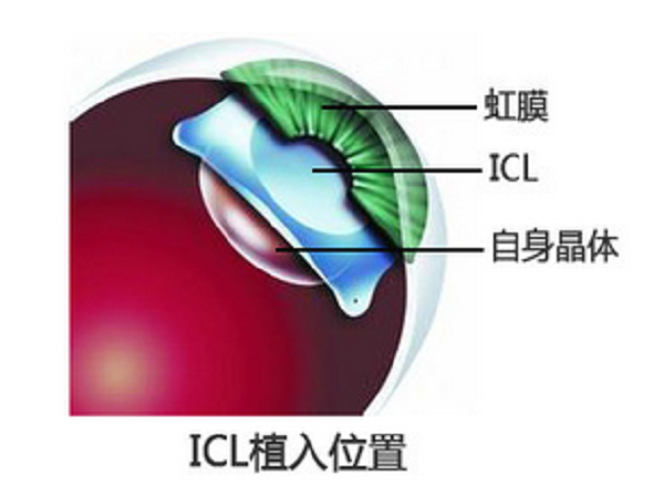 ICL人工晶體植入手術