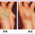 乳房再造 乳房再造