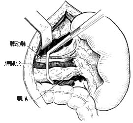 自身免疫性淋巴細胞增生綜合徵