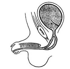 梭狀重複尿道，在中部分裂成重複