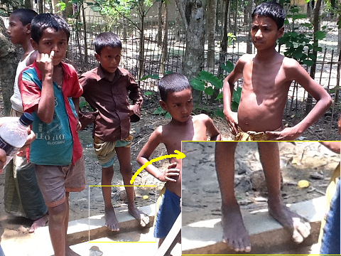 孟加拉國黑腳病兒童