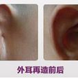 外耳再造 外耳再造
