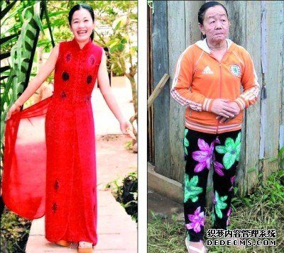 阮氏芳(越南罕見皮膚病患者) 阮氏芳(越南罕見皮膚病患者)