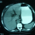 胰腺CT檢查 胰腺CT檢查