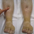 孕婦小腿浮腫 孕婦小腿浮腫