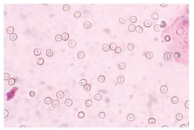 尿紅細胞