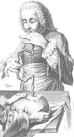 18世紀的頭部穿孔手術圖