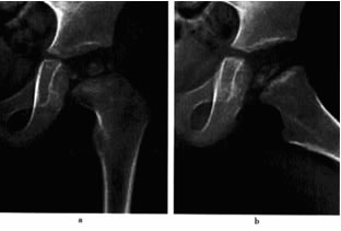 3左側投骨頭骨骺缺血性壞死(進展期)