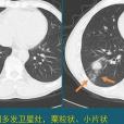 肺結核球 肺結核球