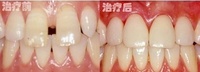 瓷貼面牙齒修復