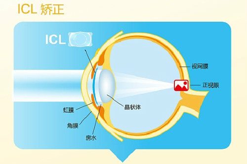 ICL晶體 ICL晶體
