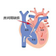 房間隔缺損(房缺) 房間隔缺損(房缺)