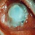 穿透性角膜移植術所致青光眼