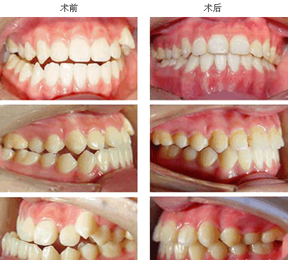 頜面畸形矯正 頜面畸形矯正