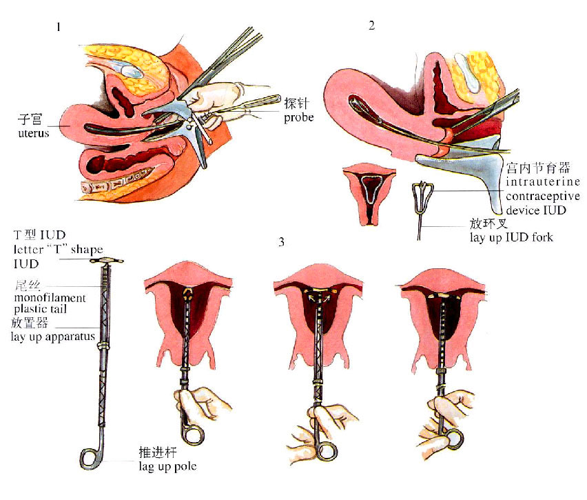 宮內節育器放置術(宮內避孕器放置術)