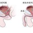 前列腺增生防治要訣