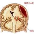 腦疝危象 腦疝危象