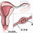 宮外孕現象