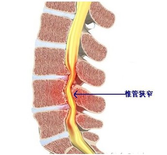 腰椎管狹窄