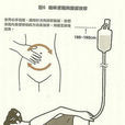 清潔灌腸