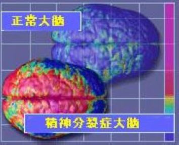 精神分裂者大腦和正常人大腦的區別