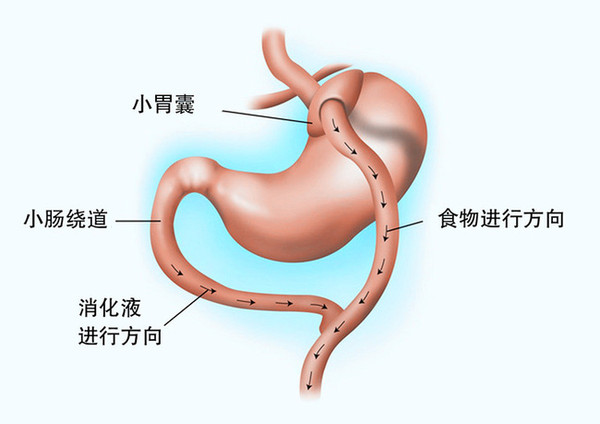 腸吸收不良綜合徵