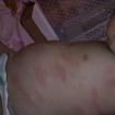 皮膚蕁麻疹