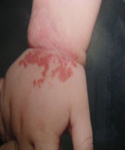 嬰兒手部蔓狀血管瘤