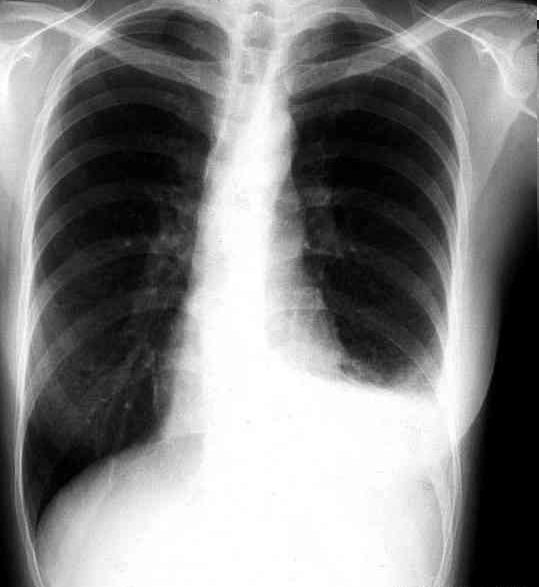 肺腫瘤X光片
