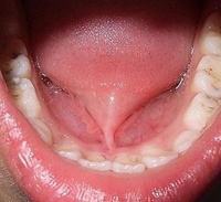 唇系帶延長術
