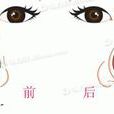 歪鼻矯正 歪鼻矯正
