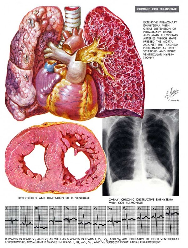 肺原性心臟病