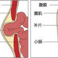 腹壁疾病 腹壁疾病
