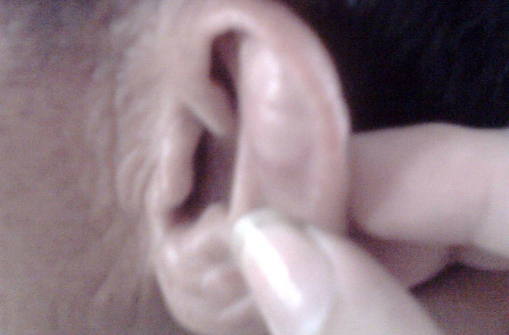 耳廓假性囊腫