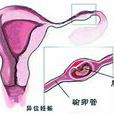 卵巢宮外孕