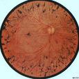 環狀視網膜變性