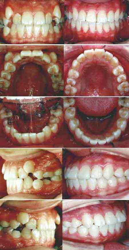 牙齒腐蝕