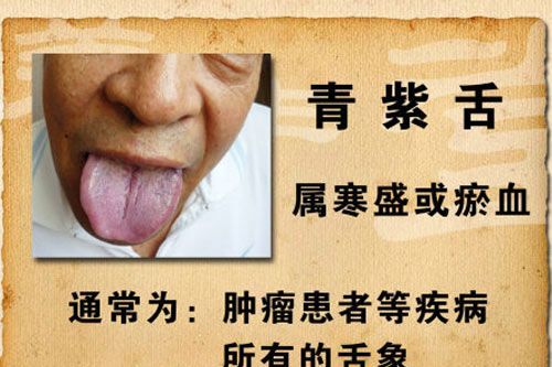 青紫舌 青紫舌