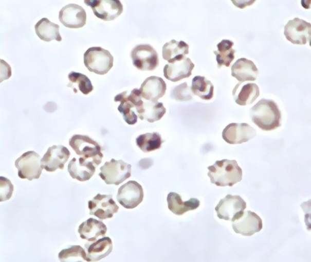 尿紅細胞