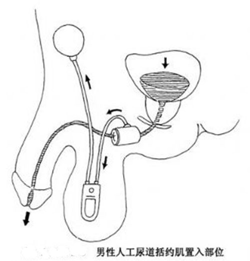 圖2 男性人工尿道植入部位